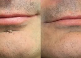 🎁 -50% AKCIÓ! PURESHADE® 2 az 1-ben mikrotűs és hidrokolloid tapasz 🍀 | Láthatatlan tapasz arcra és testre | Bőrhibák, aknék és bőröregedés jeleinek ápolására