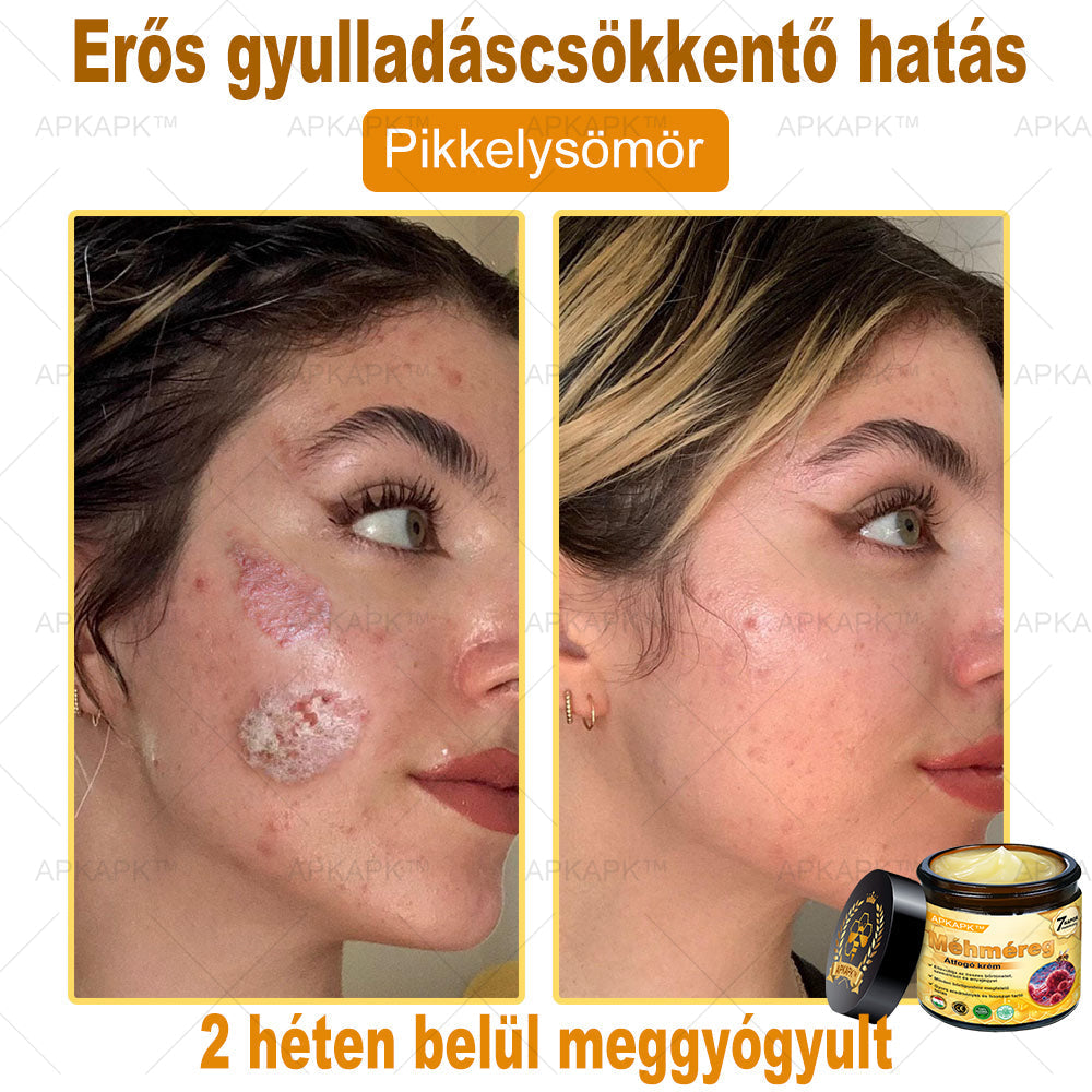 🔥🔥 Már csak 5 lehetőség! Használd ki a 50% kedvezményt! APKAPK® 🐝 Méhméreg krém segít a ráncok, hegek, pigmentfoltok, striák, akné és egyéb bőrproblémák kezelésében. Ne hagyd ki – kattints a linkre és élvezd a kedvezményt még ma! 🛒💚