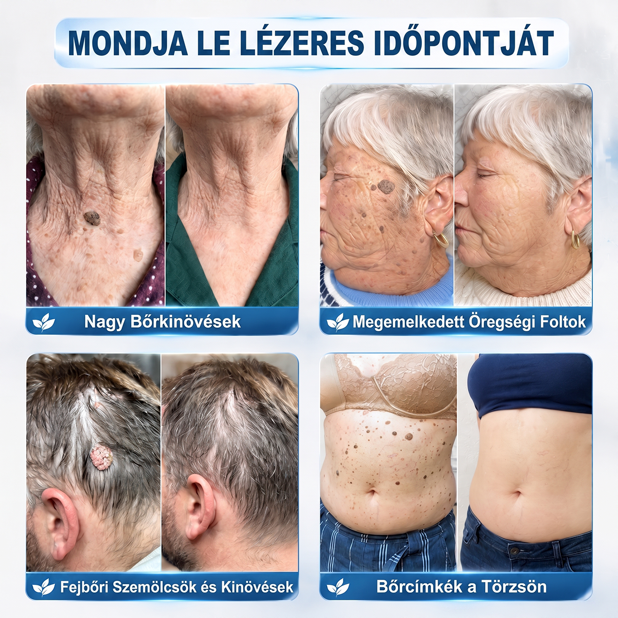 ✨ 🔥 Most 50% kedvezménnyel elérhető! ✨🚢 Hiskin® 7 napos Szemölcseltávolító Roll-on Ápoló Folyadék (Fájdalommentes rollerball technológia, hegek nélkül) 🐬