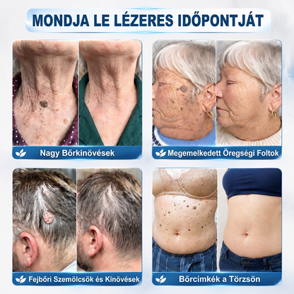 ✨ 🔥 Most 50% kedvezménnyel elérhető! ✨🚢 Hiskin® 7 napos Szemölcseltávolító Roll-on Ápoló Folyadék (Fájdalommentes rollerball technológia, hegek nélkül) 🐬