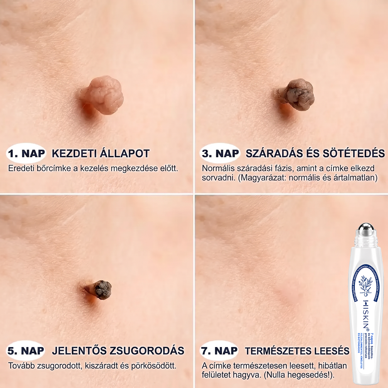 ✨ 🔥 Most 50% kedvezménnyel elérhető! ✨🚢 Hiskin® 7 napos Szemölcseltávolító Roll-on Ápoló Folyadék (Fájdalommentes rollerball technológia, hegek nélkül) 🐬