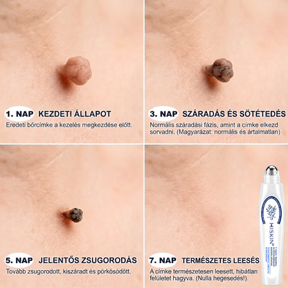 ✨ 🔥 Most 50% kedvezménnyel elérhető! ✨🚢 Hiskin® 7 napos Szemölcseltávolító Roll-on Ápoló Folyadék (Fájdalommentes rollerball technológia, hegek nélkül) 🐬