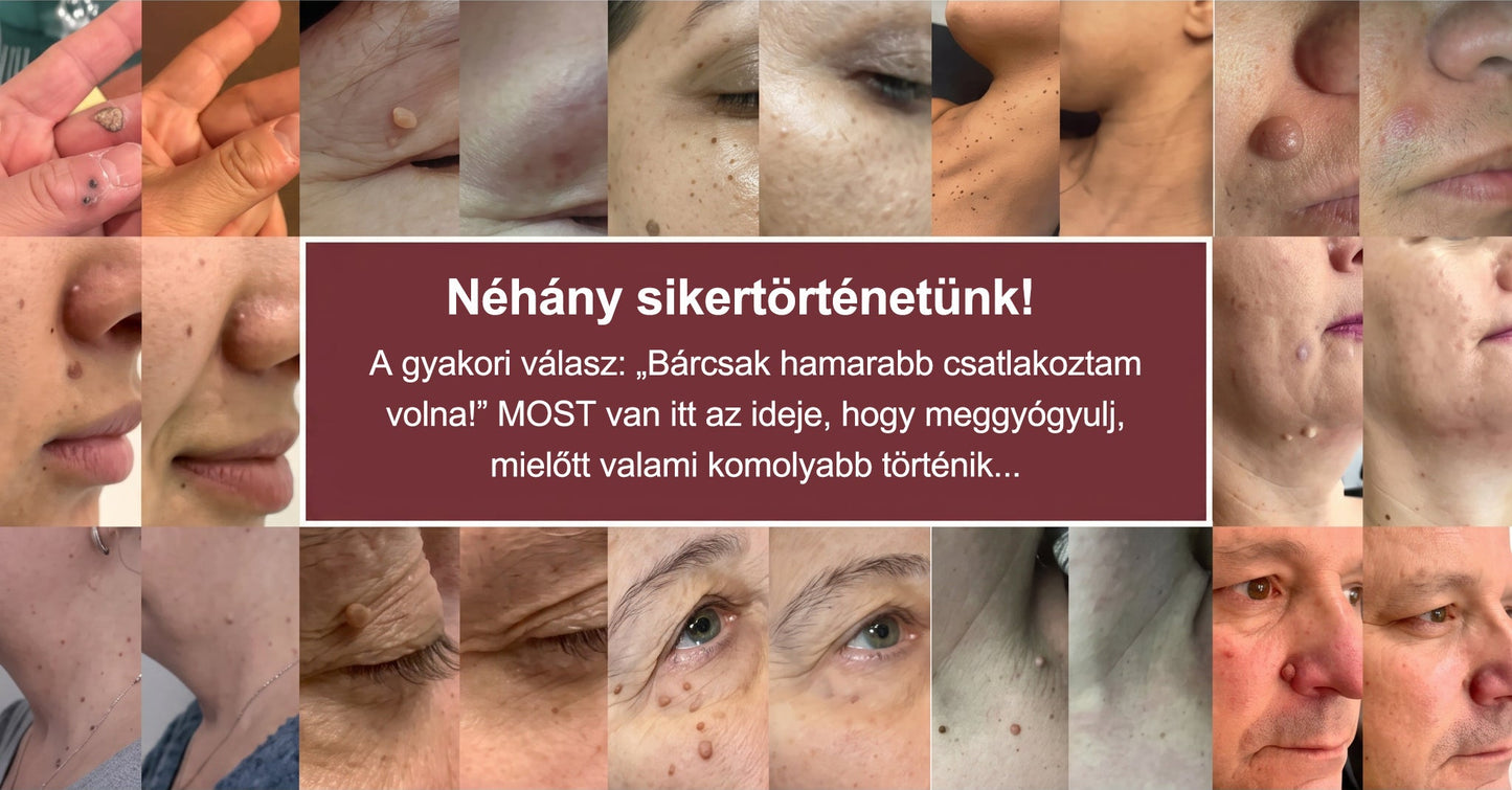 🎁 -50% AKCIÓ! PURESHADE® 2 az 1-ben mikrotűs és hidrokolloid tapasz 🍀 | Láthatatlan tapasz arcra és testre | Bőrhibák, aknék és bőröregedés jeleinek ápolására