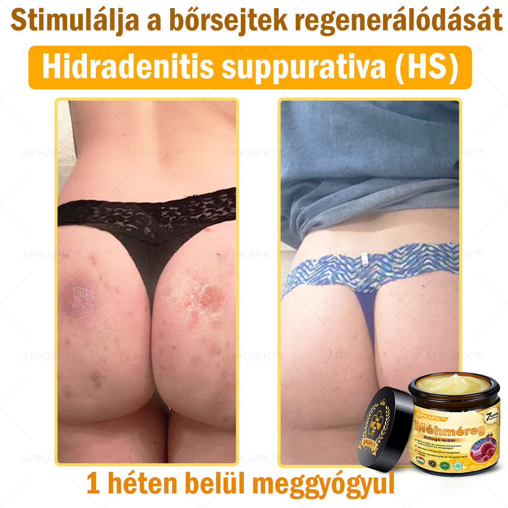 🔥🔥 Már csak 5 lehetőség! Használd ki a 50% kedvezményt! APKAPK® 🐝 Méhméreg krém segít a ráncok, hegek, pigmentfoltok, striák, akné és egyéb bőrproblémák kezelésében. Ne hagyd ki – kattints a linkre és élvezd a kedvezményt még ma! 🛒💚