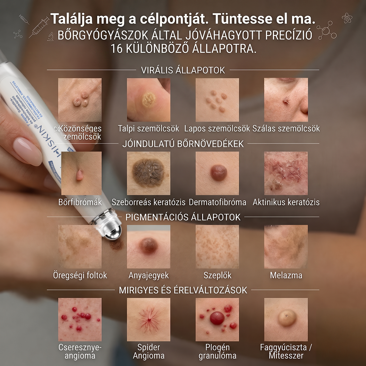 ✨ 🔥 Most 50% kedvezménnyel elérhető! ✨🚢 Hiskin® 7 napos Szemölcseltávolító Roll-on Ápoló Folyadék (Fájdalommentes rollerball technológia, hegek nélkül) 🐬