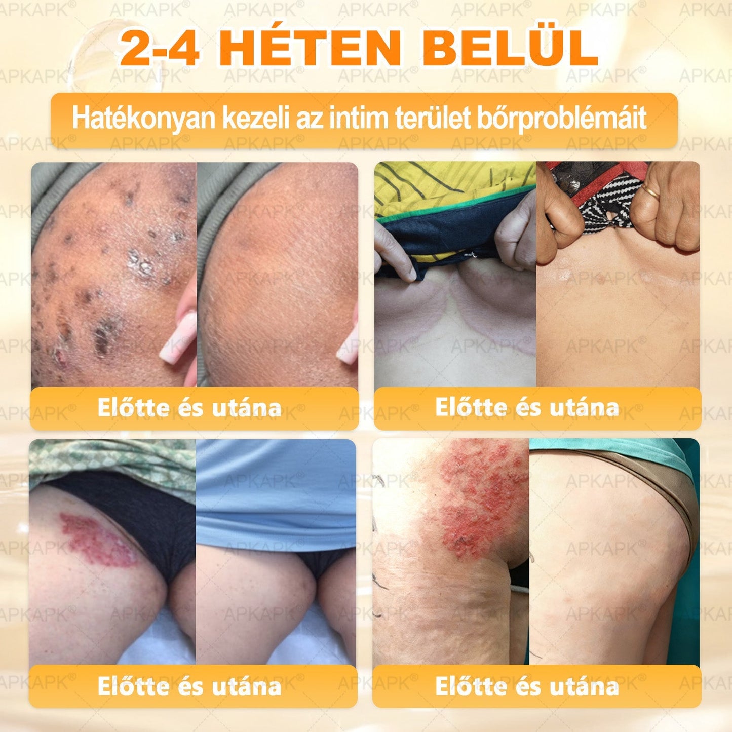 ✨✨ 𝖠𝖯𝖪𝖠𝖯𝖪® 🐝 Méhméreges Bőrmegújító Krém – Ráncok, Hegek, Pigmentfoltok, Striák, Akné, Ekcéma, Pikkelysömör Ellen