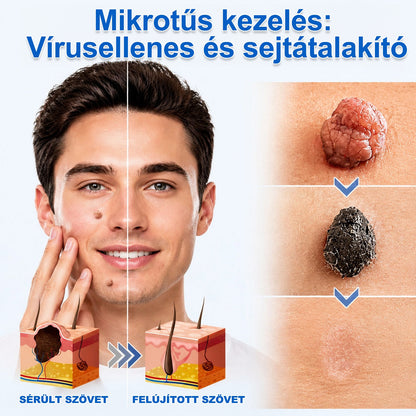 🎁 -50% AKCIÓ! PURESHADE® 2 az 1-ben mikrotűs és hidrokolloid tapasz 🍀 | Láthatatlan tapasz arcra és testre | Bőrhibák, aknék és bőröregedés jeleinek ápolására