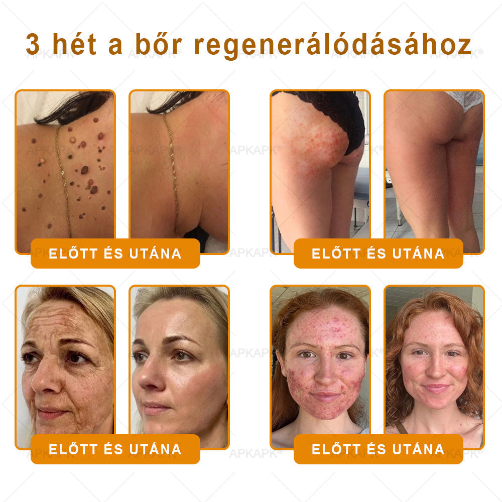 ✨✨ 𝖠𝖯𝖪𝖠𝖯𝖪® 🐝 Méhméreges Bőrmegújító Krém – Ráncok, Hegek, Pigmentfoltok, Striák, Akné, Ekcéma, Pikkelysömör Ellen