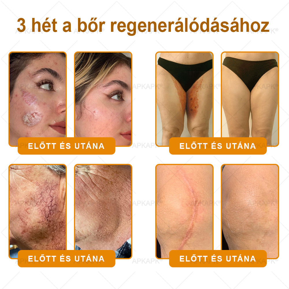 ✨✨ 𝖠𝖯𝖪𝖠𝖯𝖪® 🐝 Méhméreges Bőrmegújító Krém – Ráncok, Hegek, Pigmentfoltok, Striák, Akné, Ekcéma, Pikkelysömör Ellen