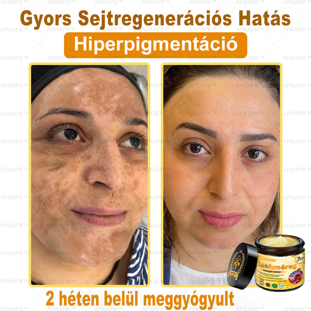 🔥🔥 Már csak 5 lehetőség! Használd ki a 50% kedvezményt! APKAPK® 🐝 Méhméreg krém segít a ráncok, hegek, pigmentfoltok, striák, akné és egyéb bőrproblémák kezelésében. Ne hagyd ki – kattints a linkre és élvezd a kedvezményt még ma! 🛒💚